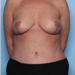 Mommy Makeover Before & After Patient #34313